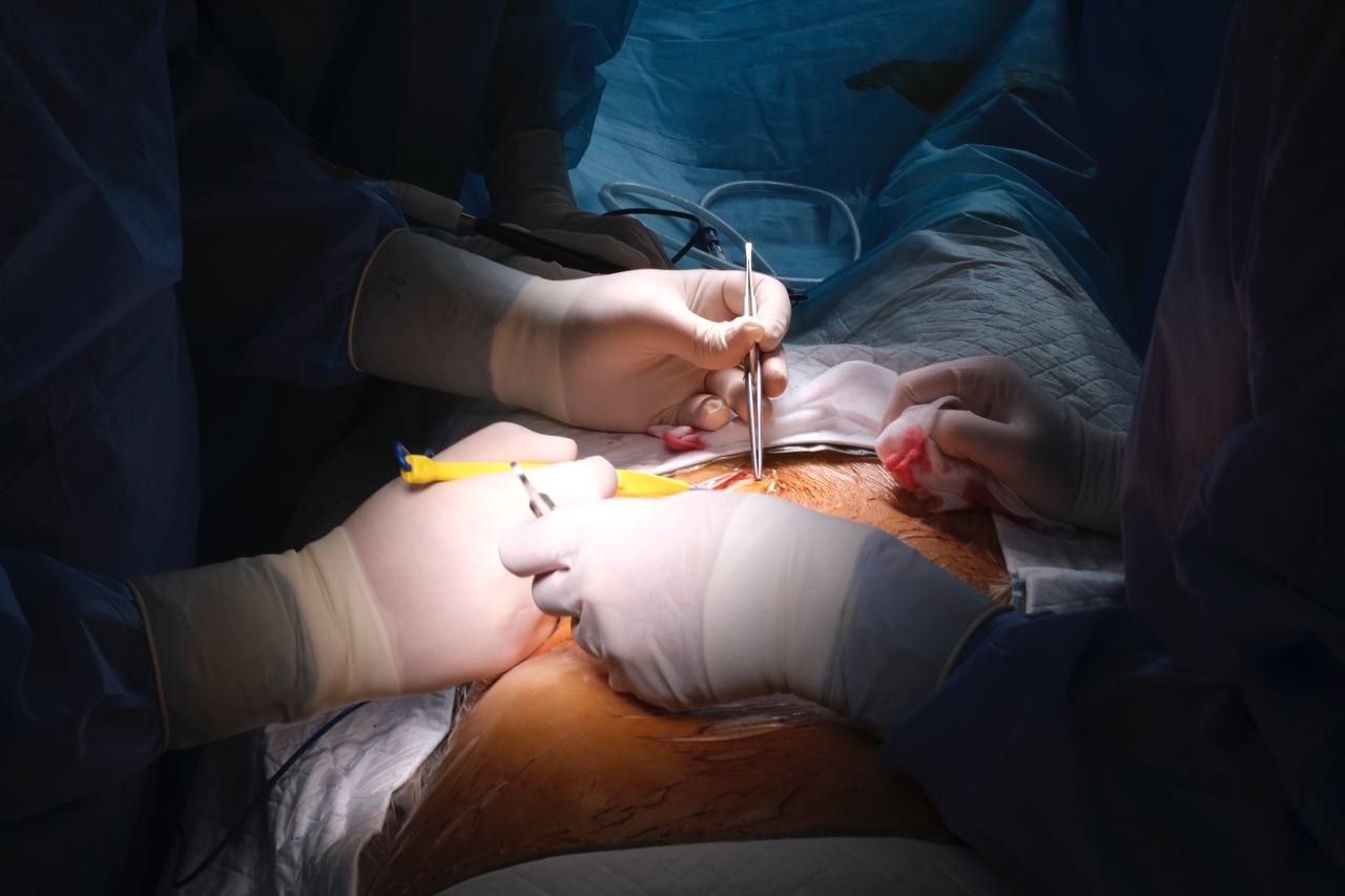У Києві хірурги вперше в Україні провели одномоментну трансплантацію комплексу “серце-печінка”.